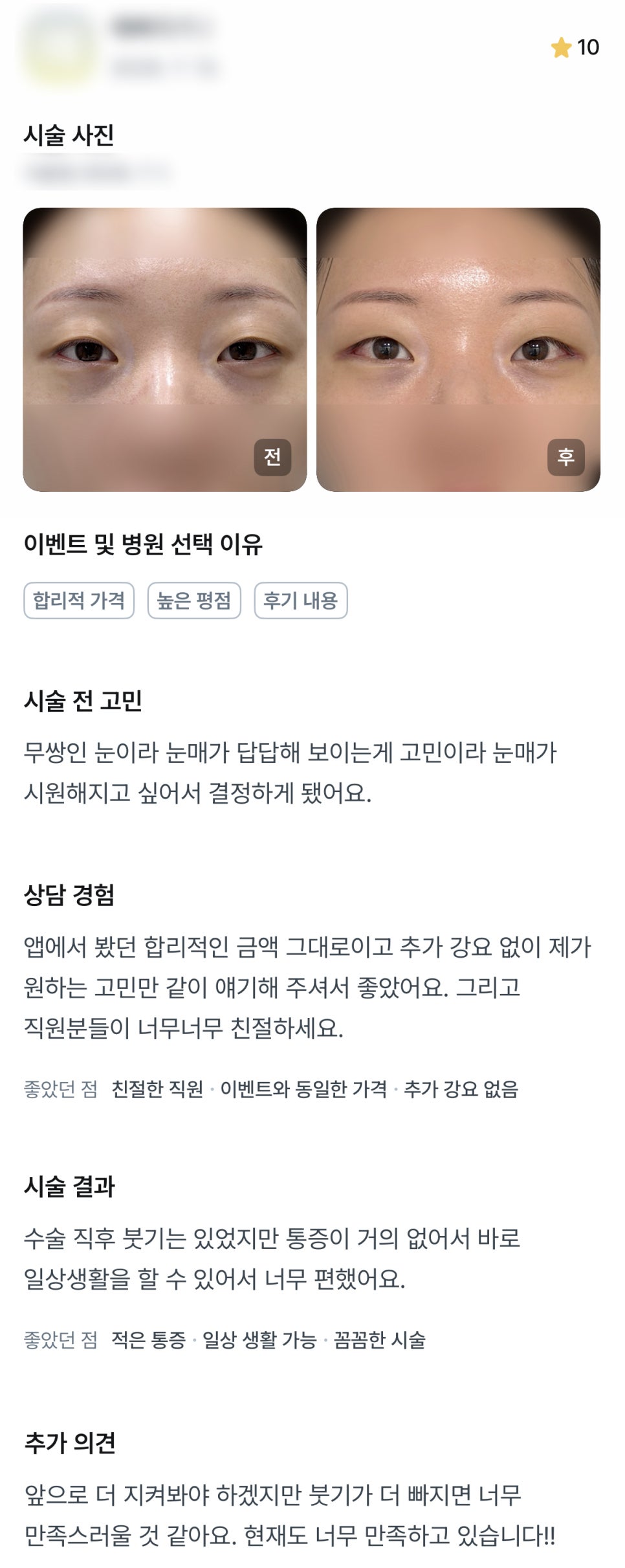 DM Posterior and Lower Canthoplasty Surgery Review, “I’m So Satisfied After the Surgery!” image 1