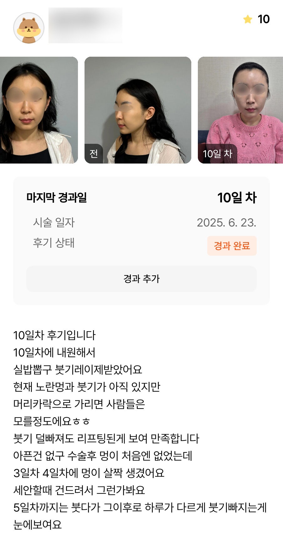 반거상 후기."붓기 덜 빠져도 리프팅 된게 보여 만족합니다!" 관련 이미지 1