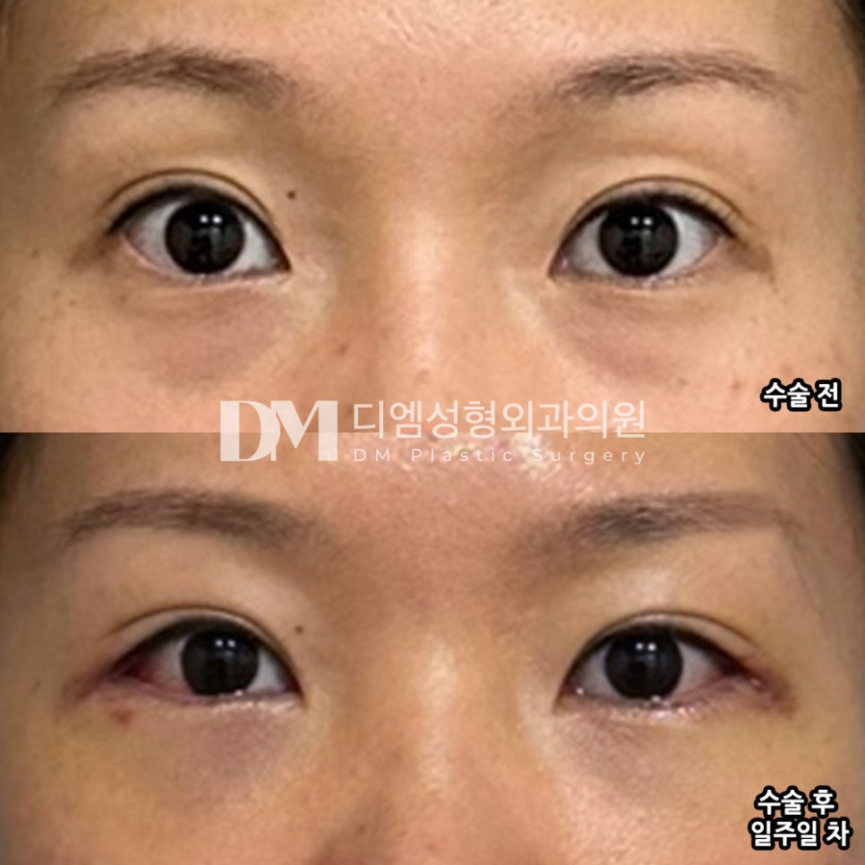 Eye Surgery Review. "My dull impression improved, and my eyes opened up and became a little bigger!" image 2
