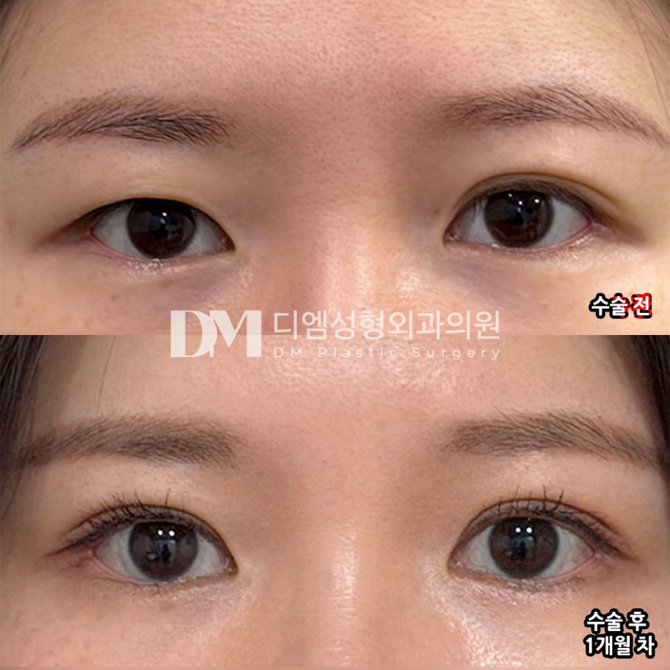 DM Double Eyelid/Eye Plastic Surgery Review, “Everything has settled well, so I’m going about my daily life without any problems!” image 2