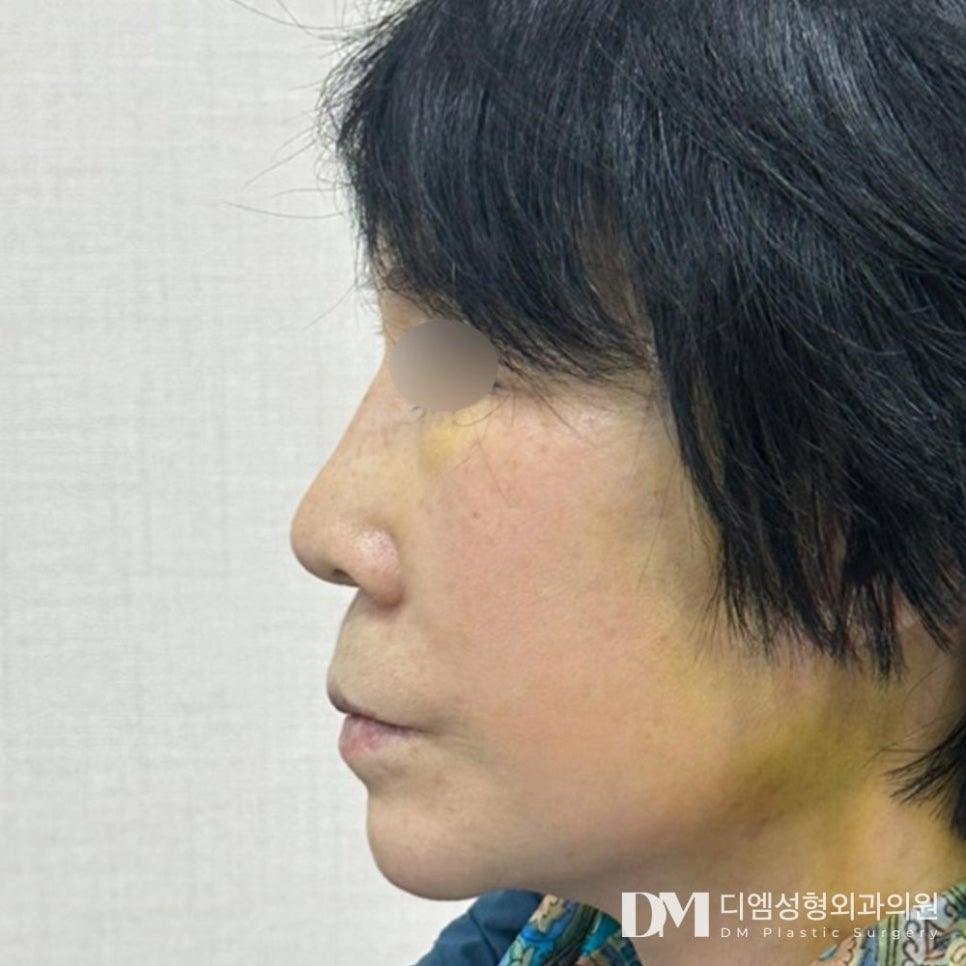 안면거상, 개인별 맞춤형 플랜으로 더욱 높아진 만족도! 관련 이미지 7