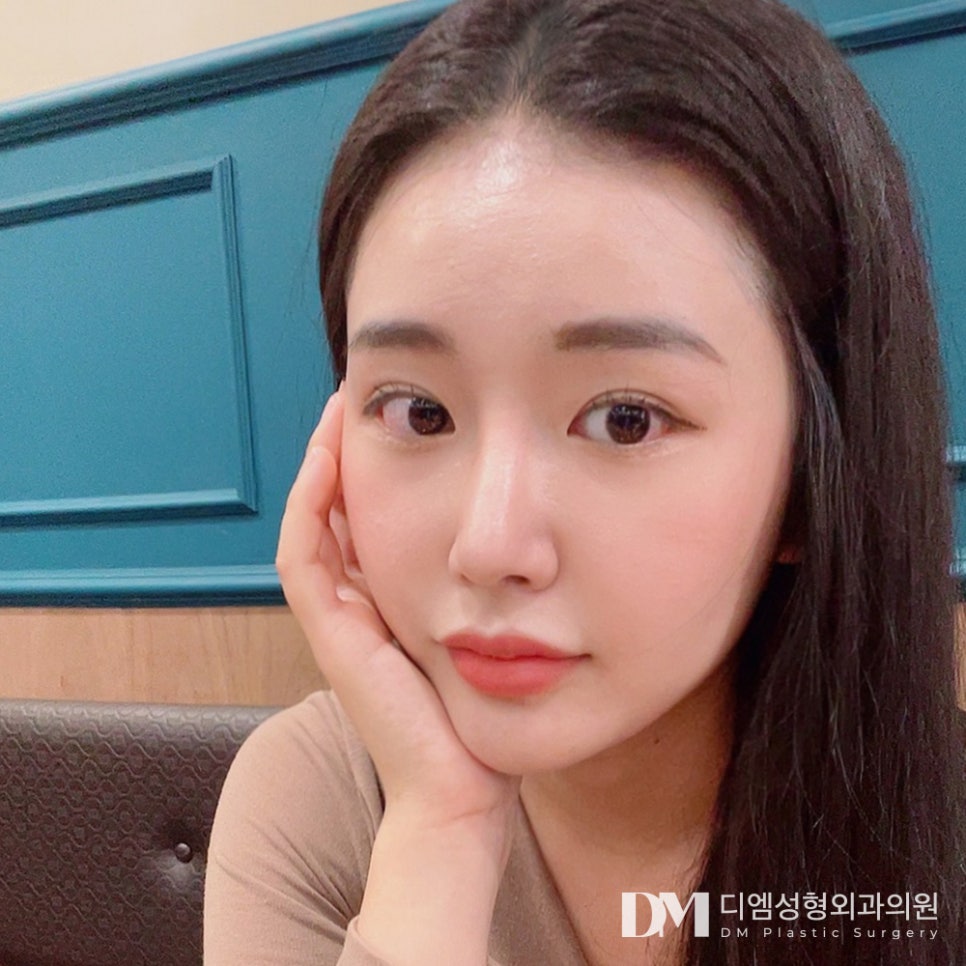 Want to Look Naturally More Beautiful with Double-Eyelid Surgery for the New Year? image 11