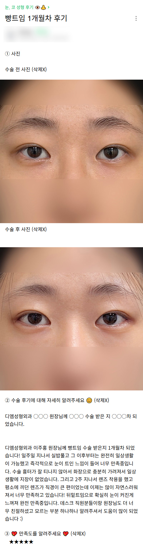 디엠 빵트임/뒤밑트임 후기, “눈이 트인 느낌이 들어 너무 만족 중입니다!” 관련 이미지 1