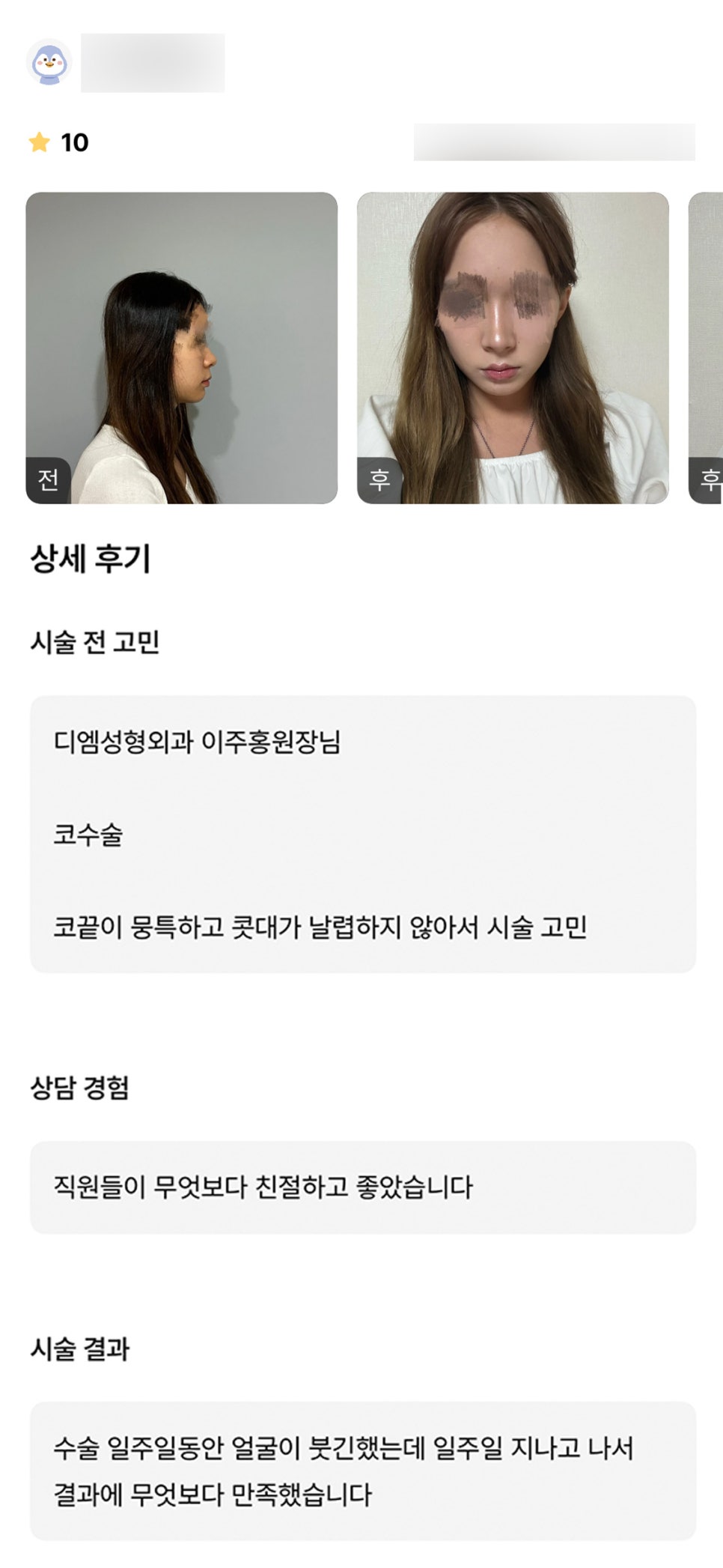 코성형 후기."일주일 후부터 완전 만족이요!" 관련 이미지 1