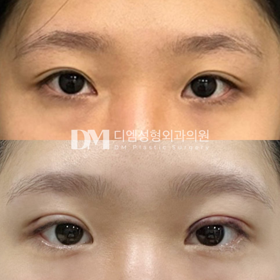 Eye Revision Surgery Review: “There’s Still Some Swelling, but the Surgery Itself Was Fine!” image 2