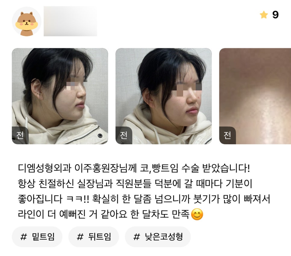 Rhinoplasty Review: “Now that the swelling has gone down, the shape looks even prettier, so I’m very satisfied!” image 1
