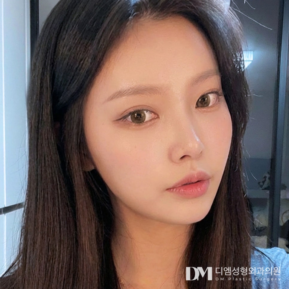 디엠 트임성형 전후사진, 전체적으로 답답한 눈매 개선 방법은? 관련 이미지 1