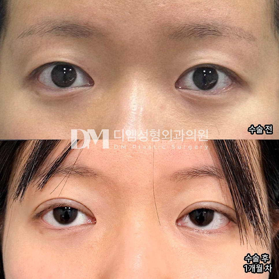 눈재수술 후기."일상 생활 무리 없이 가능하고 붓기도 빨리 빠졌어요!" 관련 이미지 2