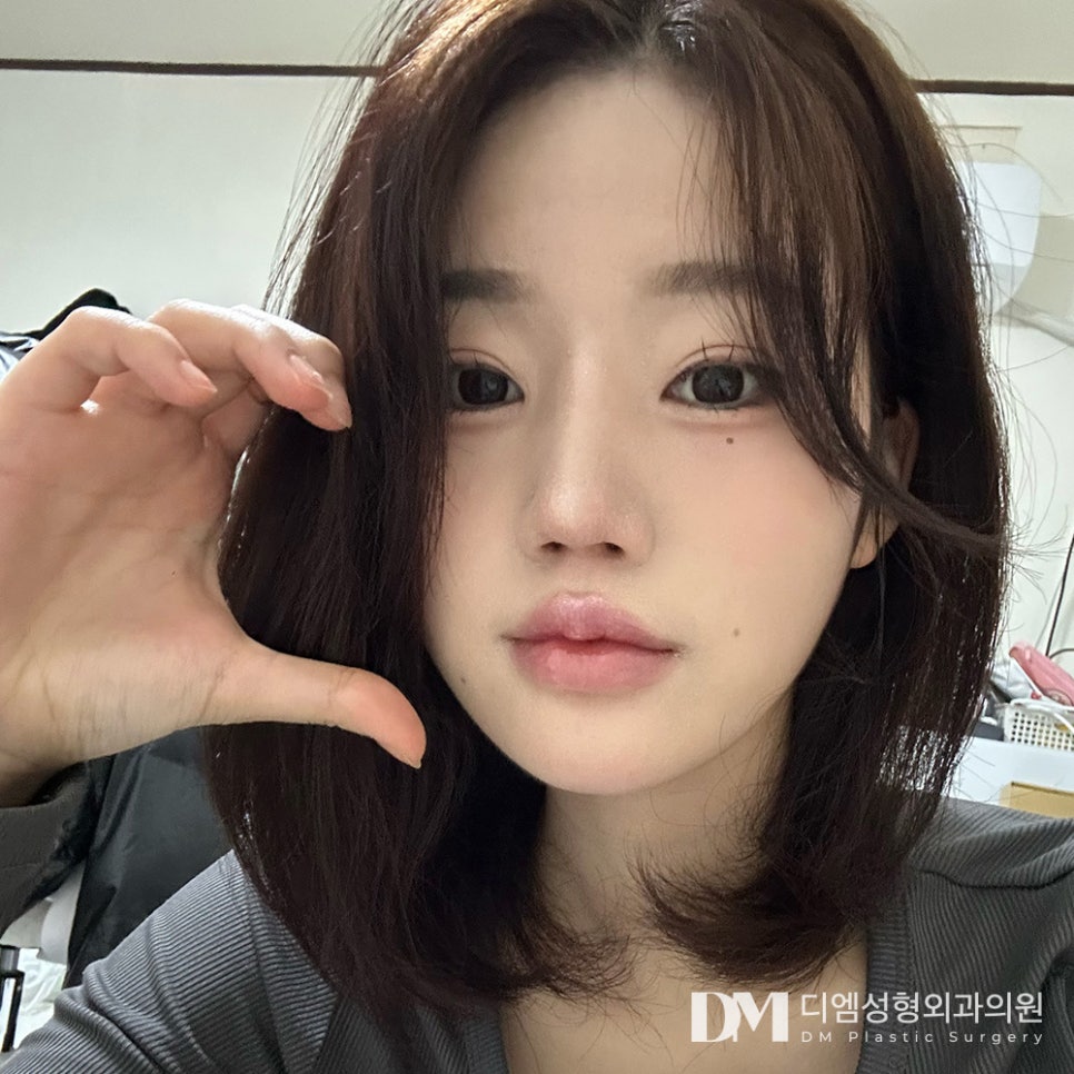 Revision Rhinoplasty, So It Can Be Your Last Nose Surgery image 1