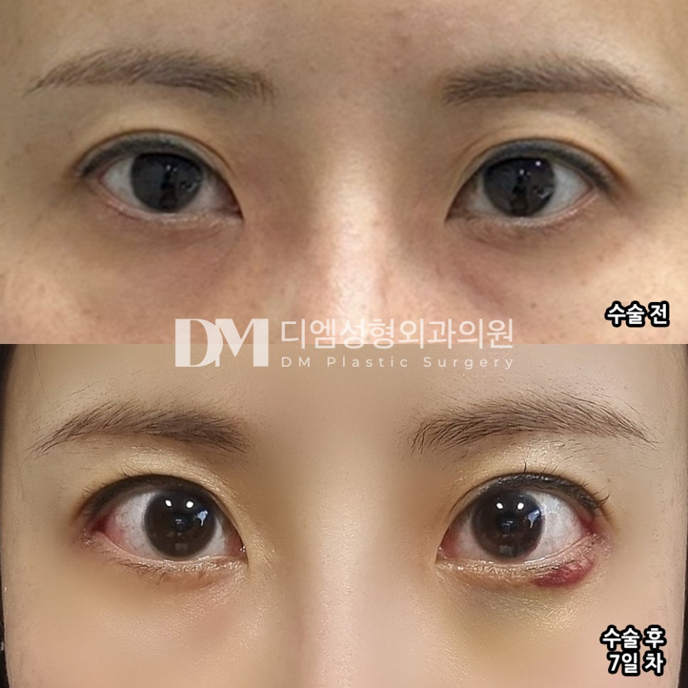 Lower Canthoplasty Review: “I’m so happy it turned out just the way I wanted!” image 2