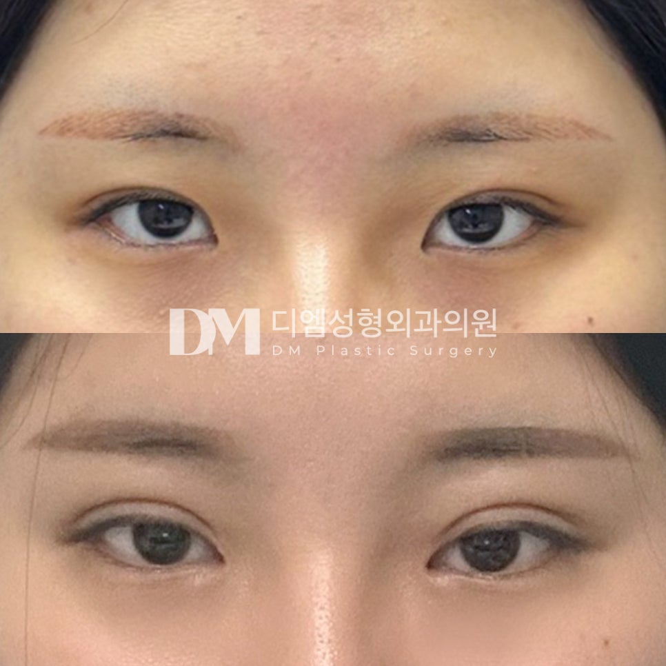 Eye Surgery Review: “There wasn’t much pain, and I wasn’t uncomfortable at all!” image 2