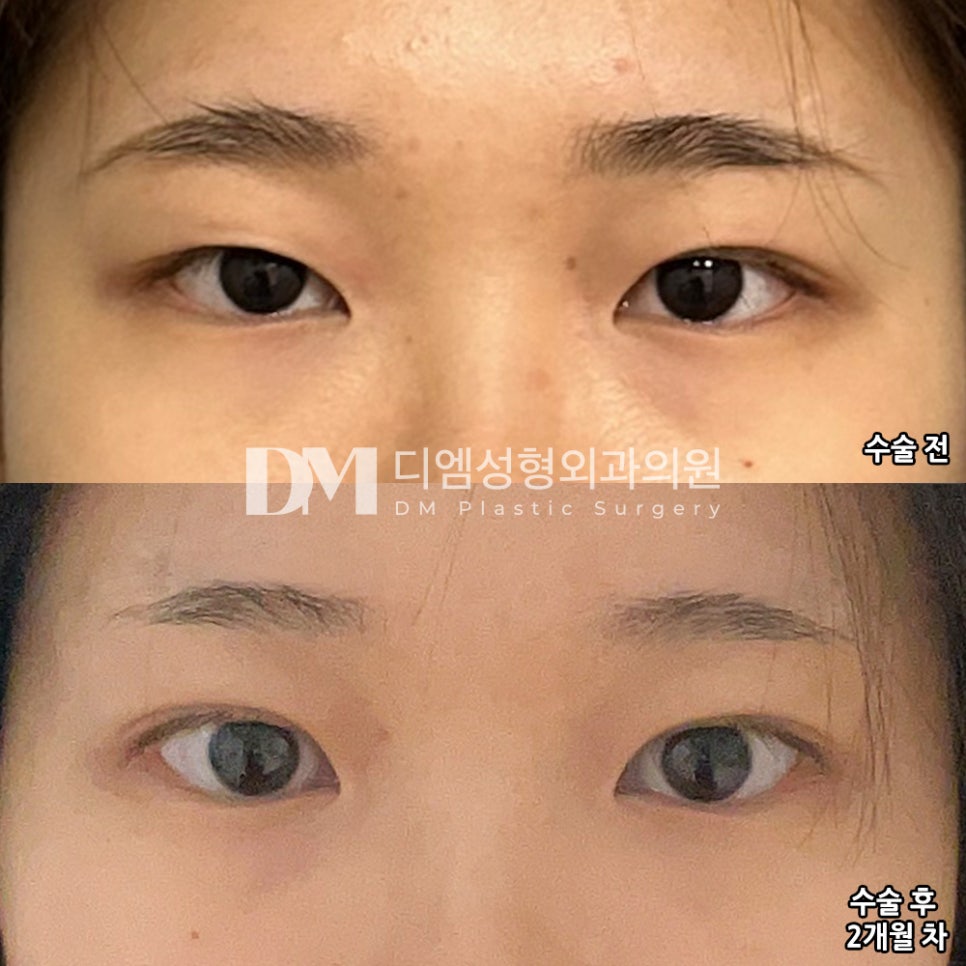 눈재수술 후기."주변에서 수술한 티 별로 나지 않는다고 말해줄 정도로 회복이 빨랐습니다." 관련 이미지 2