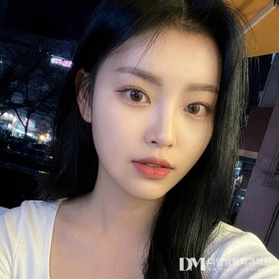 디엠 트임재수술 전후사진, 타 병원 수술 후 다시 찾는 이유는? 관련 이미지 3