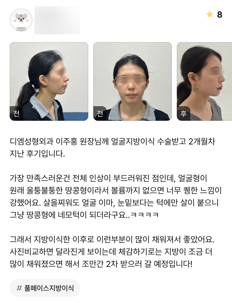 얼굴지방이식 후기."지방이식한 이후로 고민인 부분들이 채워져서 좋았어요!" 관련 이미지 1