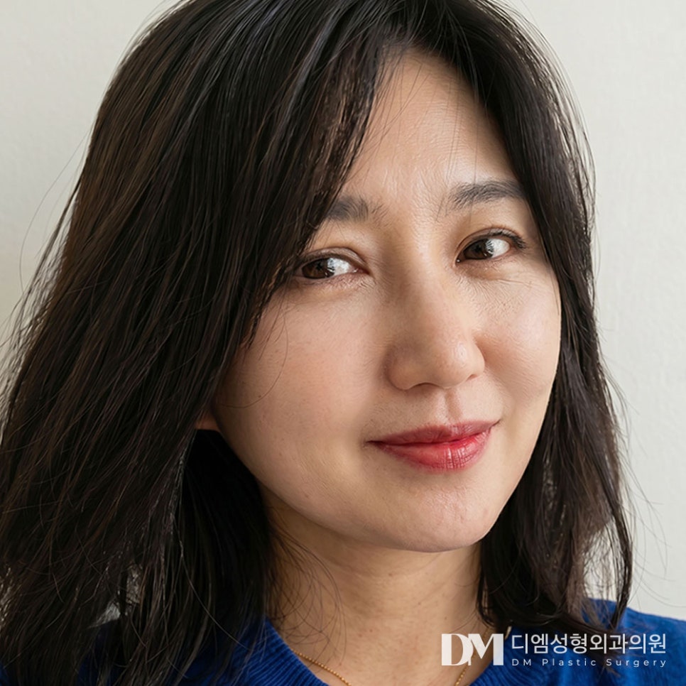 디엠 안면거상 전후사진, 처진 얼굴선의 변화를 확인해 보세요! 관련 이미지 3