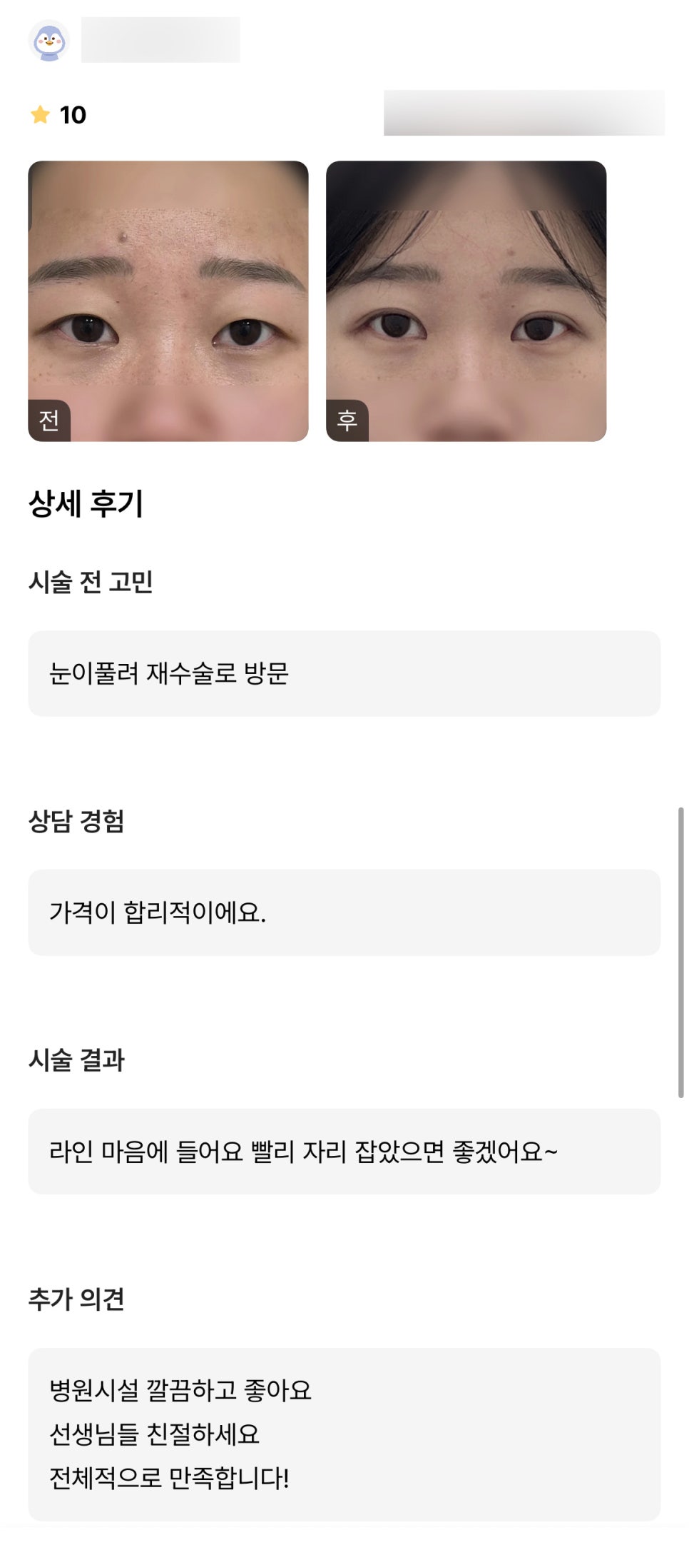 눈재수술 후기."라인이 마음에 들고 전체적으로 만족합니다!" 관련 이미지 1