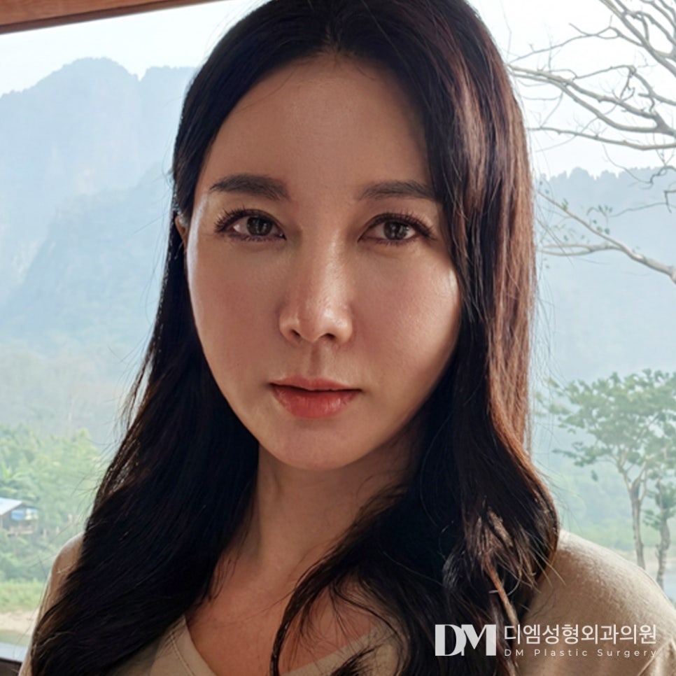 디엠 안면거상 전후사진, 얼굴 처짐과 턱선 무너짐 되살릴 수 있을까? 관련 이미지 1