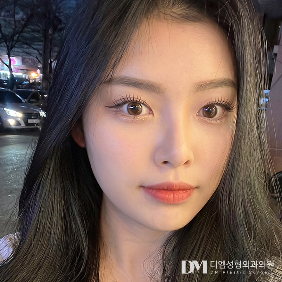 디엠 뒤밑트임 전후사진, 자연스럽게 눈매 확장을 원한다면! 관련 이미지 3