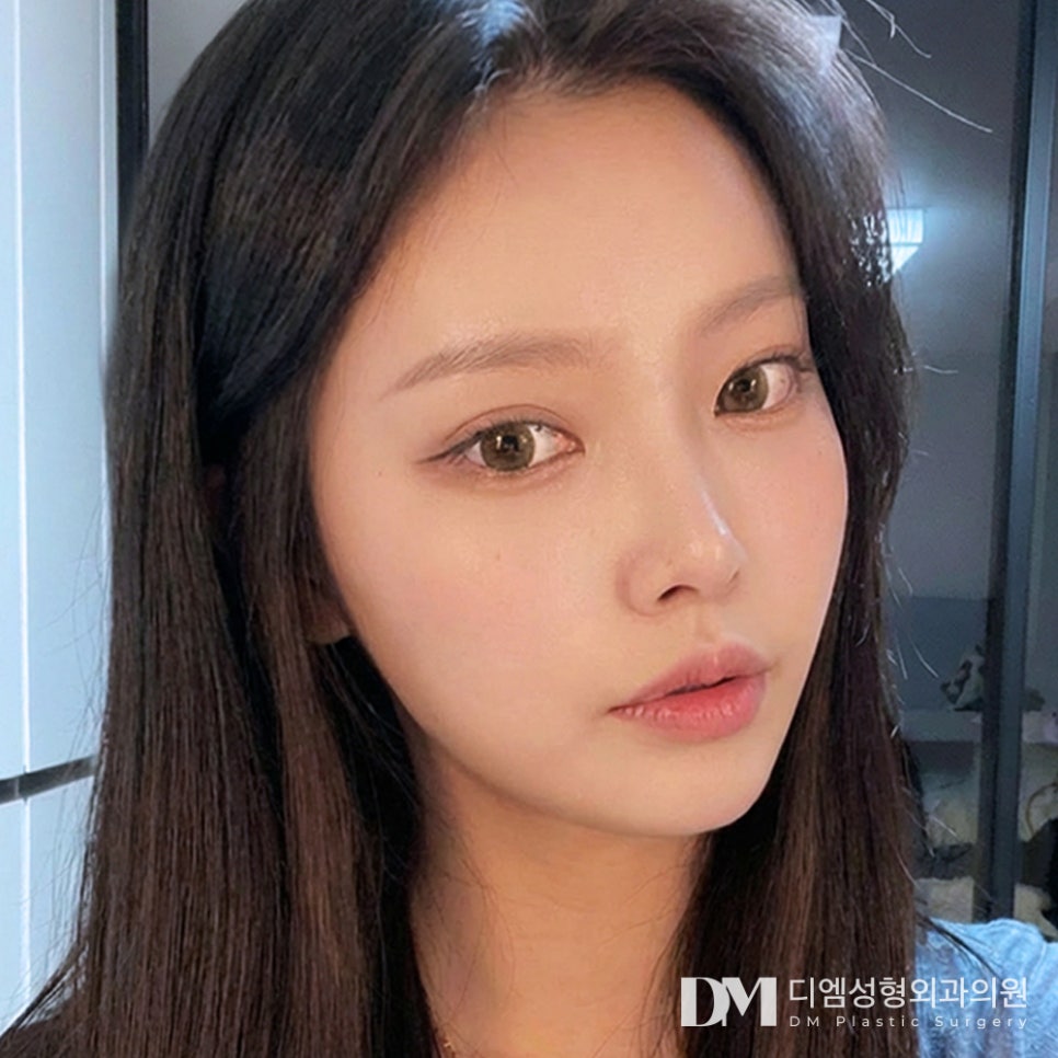 디엠 뒤밑트임 전후사진, 크고 시원한 눈매의 비결은? 관련 이미지 1