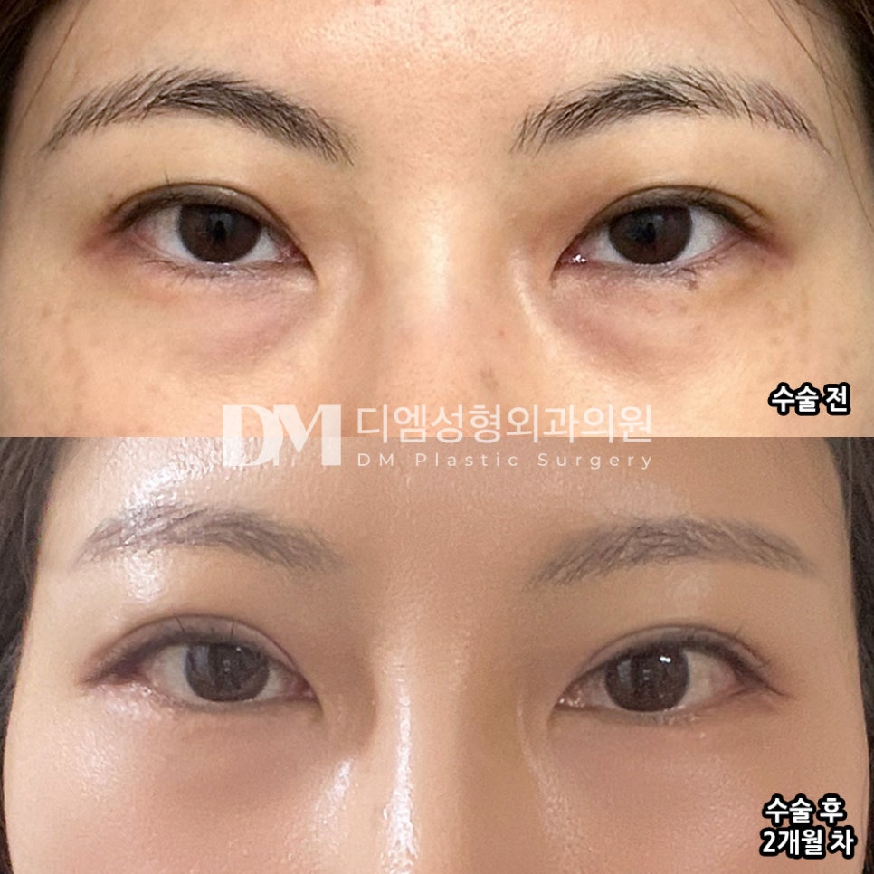 눈성형 후기."말하지 않으면 수술한 지 모를정도로 자연스럽게 예뻐진 느낌입니다!" 관련 이미지 2