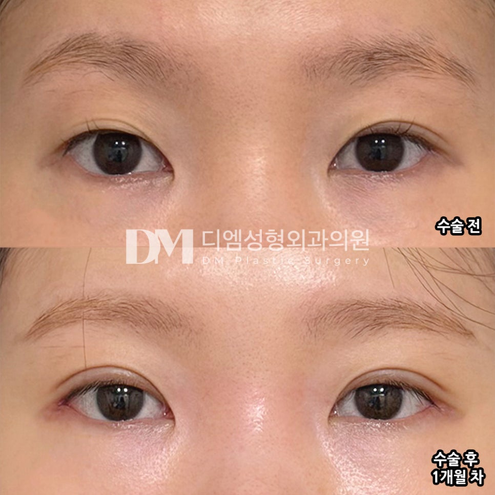 디엠 눈재수술/뒤밑트임 후기, &ldquo;붓기가 빠르게 빠져 너무 마음에 듭니다!&rdquo; 관련 이미지 2