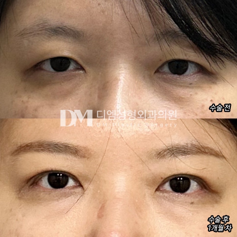 Revision Eyelid Surgery Review. “I’m glad the stressful part was corrected!” image 2