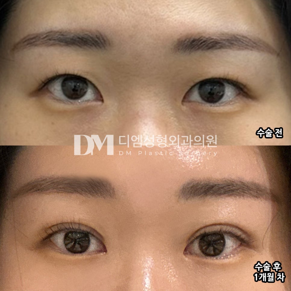 눈성형 후기."주변에서도 인상이 더 시원해 보인다고 해서 만족중입니다!" 관련 이미지 2