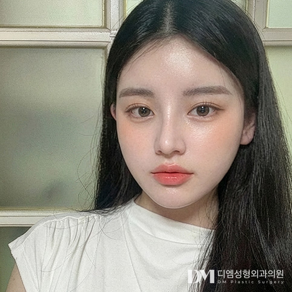 디엠 복코성형 후기사진, 뚱뚱한 코끝 슬림하게 만드는 비결은? 관련 이미지 3
