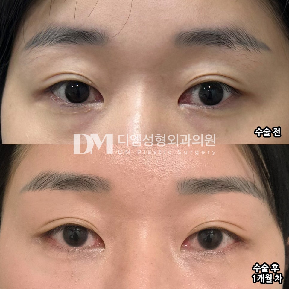 Bbang-twim Review. "One month later, the progress is good and I’m satisfied :)" image 2