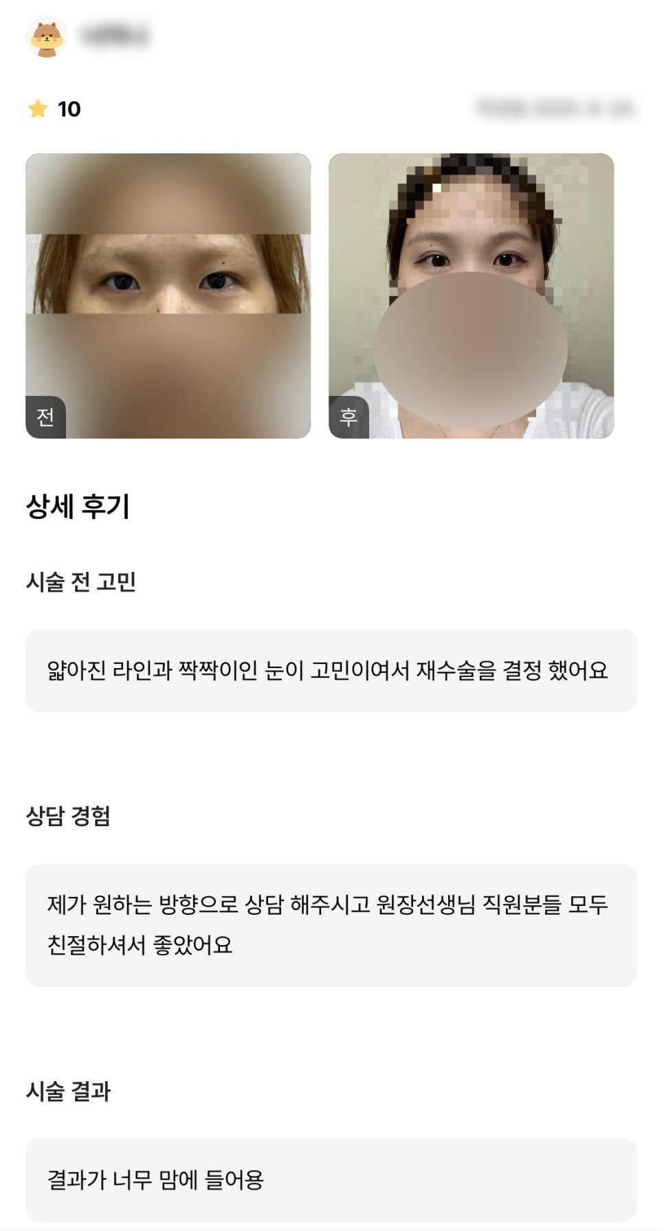 DM Reoperation for Eye Surgery Review, “I’m so happy with the procedure results!” image 1