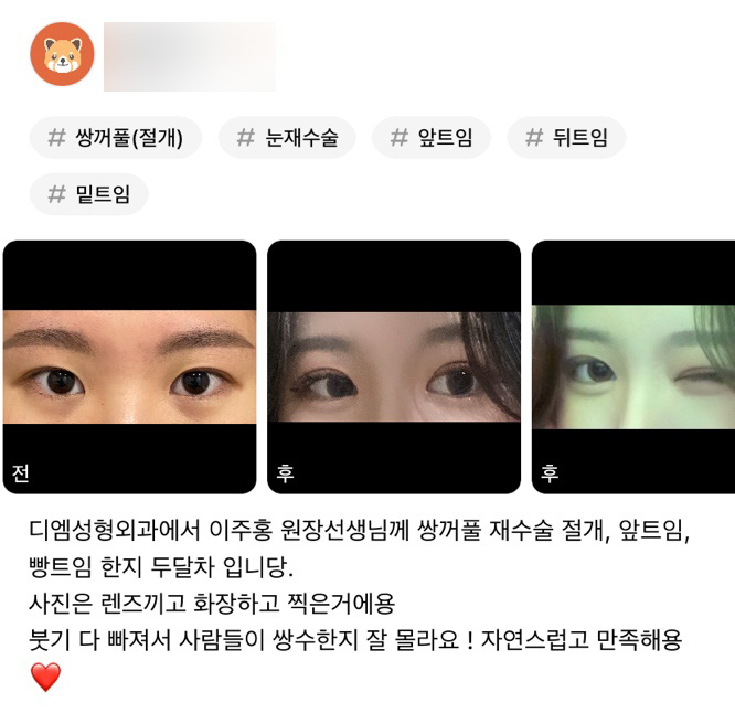 눈성형 후기."자연스럽고 만족해용 ❤" 관련 이미지 1