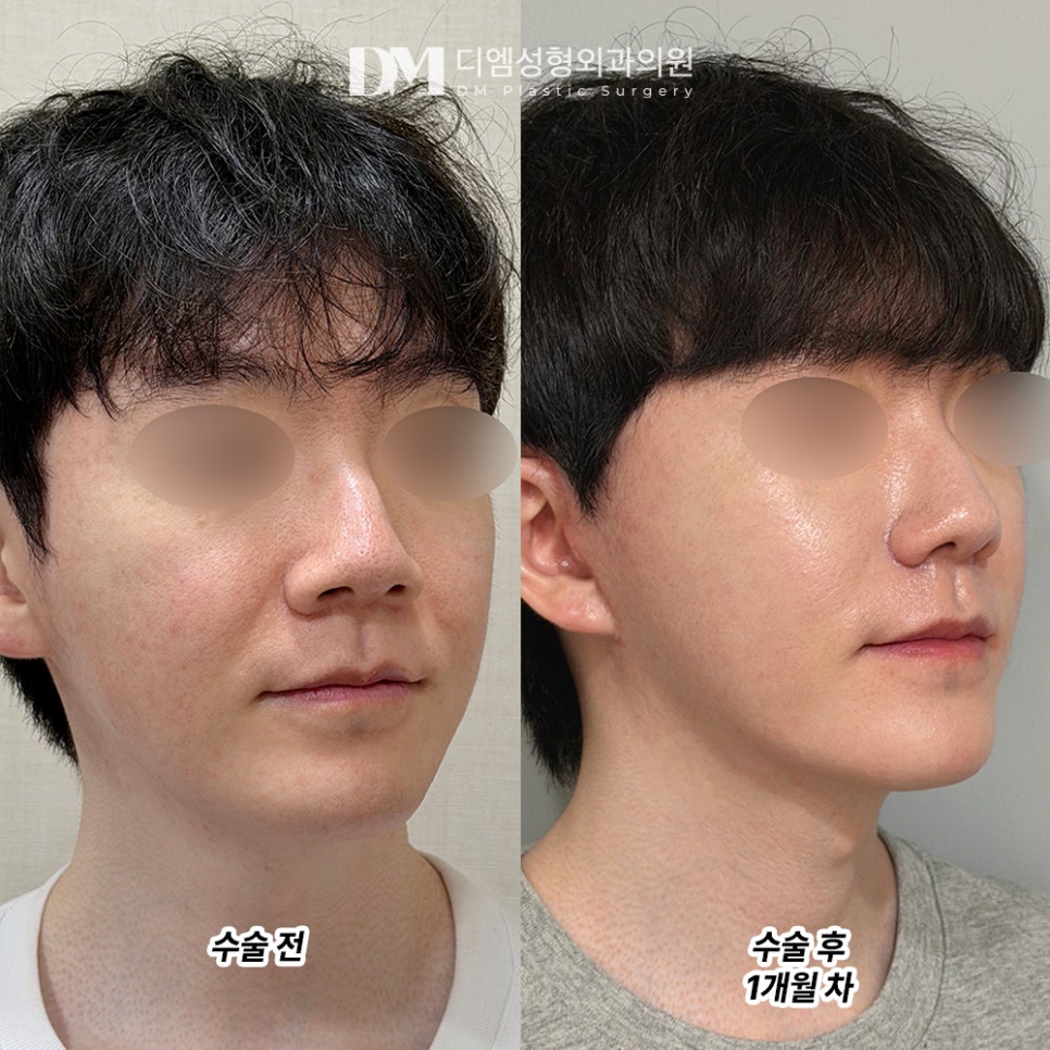 DM Male Facelift Before-and-After Photos: If You Want to Improve Overall Facial Sagging, Take Note! image 3