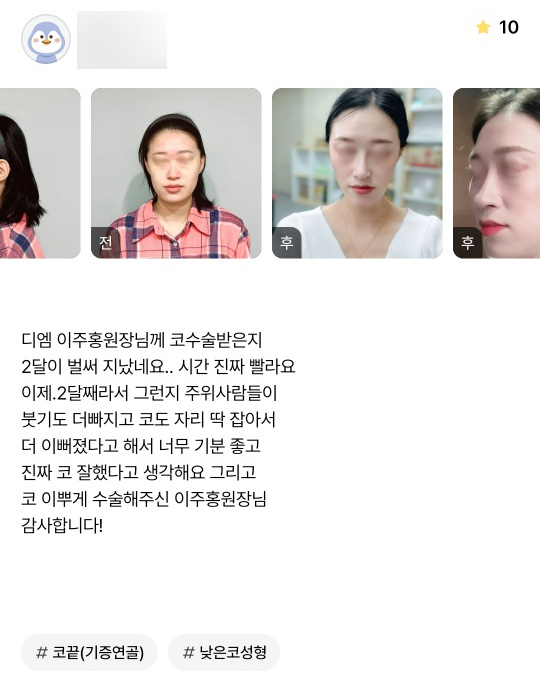 코성형 후기."더 이뻐졌다고 해서 너무 기분 좋아요!" 관련 이미지 1