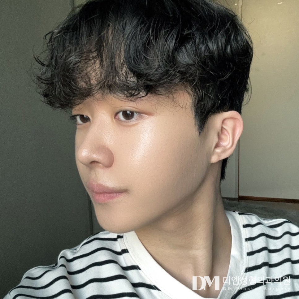 얼굴지방이식, 꺼진 부위에 볼륨과 생기를 관련 이미지 1