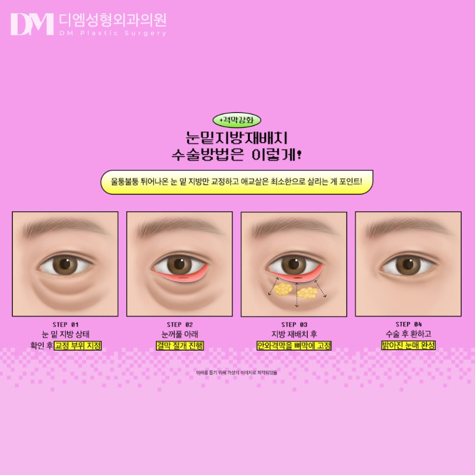눈밑지방재배치, 불룩해진 눈밑 매끈하게 되살리기! 관련 이미지 4
