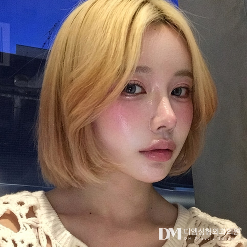 디엠 눈재수술 전후사진, 1차 수술의 실패 원인 분석 후 맞춤 수술이 중요! 관련 이미지 3