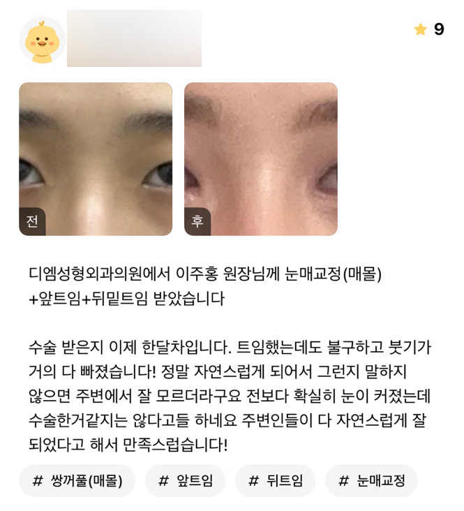눈성형 후기." 전보다 확실히 눈이 커졌는데 수술한거 같지는 않다고들 하네요" 관련 이미지 1
