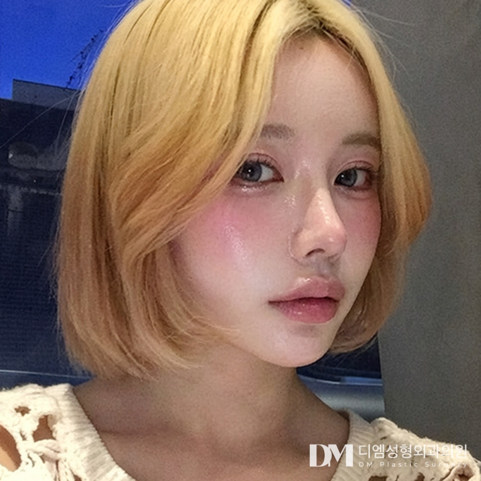 DM Ptosis Correction Before-and-After Photos: What’s the Secret to More Defined Eyes by Such a Small Difference? image 1