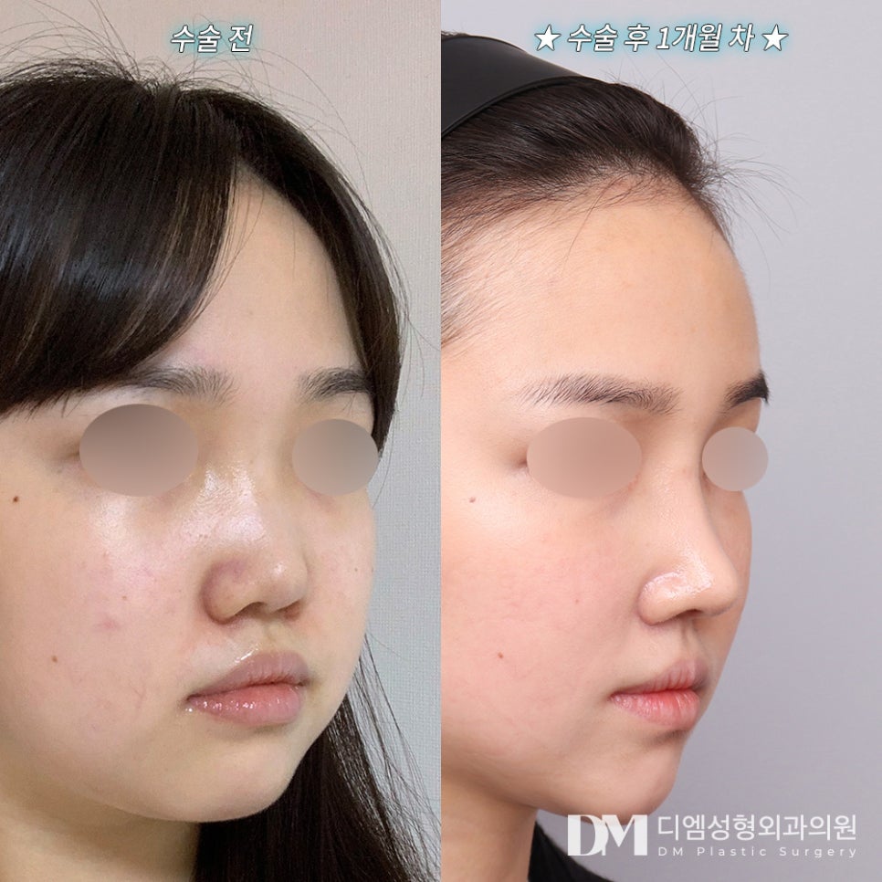 Low Bridge Nose Surgery, for a Height That Suits Me Without Looking Excessive! image 8