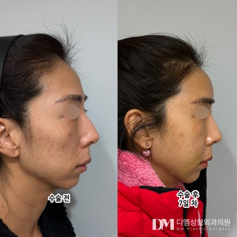 Facial Fat Grafting for a Vibrant, Youthful Appearance! image 7