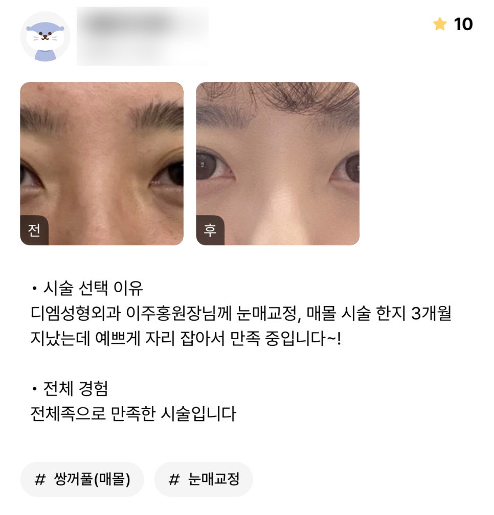 Eye Surgery Review: “I’m Satisfied That It Settled Nicely!” image 1