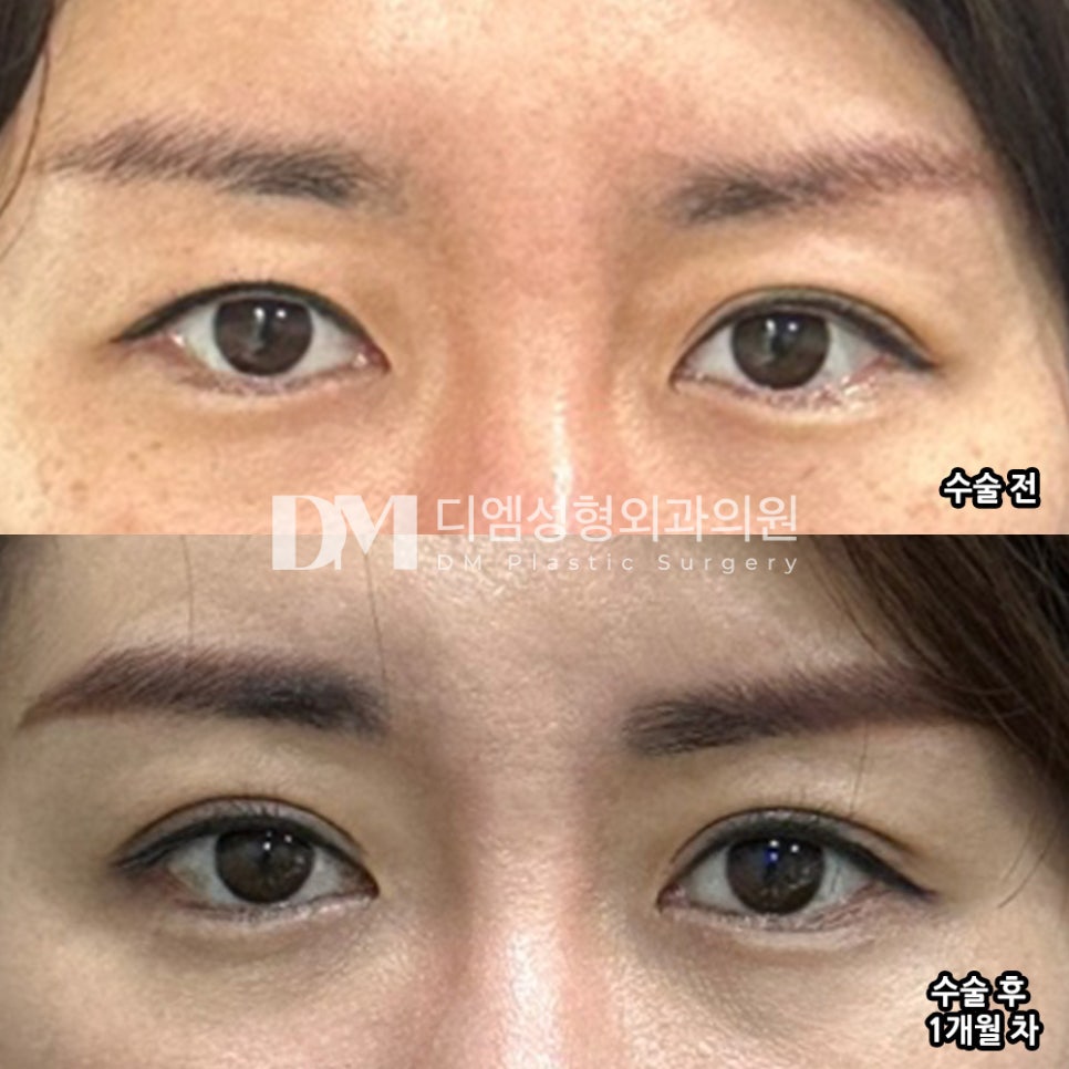눈재수술 후기."붓기가 빠져가니 더 맘에 들어요!" 관련 이미지 2