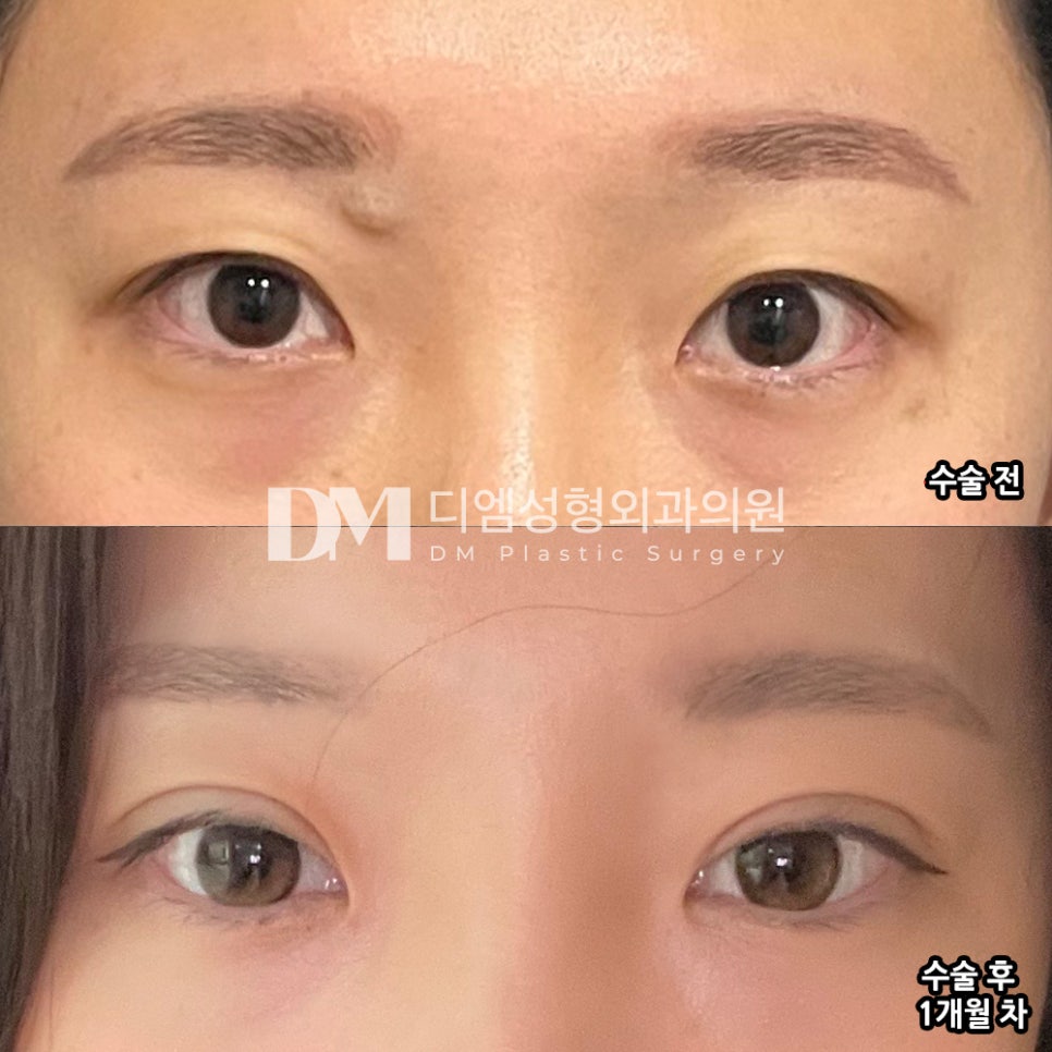 눈재수술 후기."매우 자연스러워졌어요 대만족합니다 ^^" 관련 이미지 2