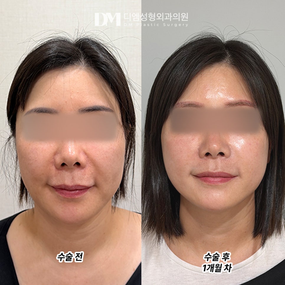디엠 안면거상 전후사진, 얼굴 처짐과 턱선 무너짐 되살릴 수 있을까? 관련 이미지 2