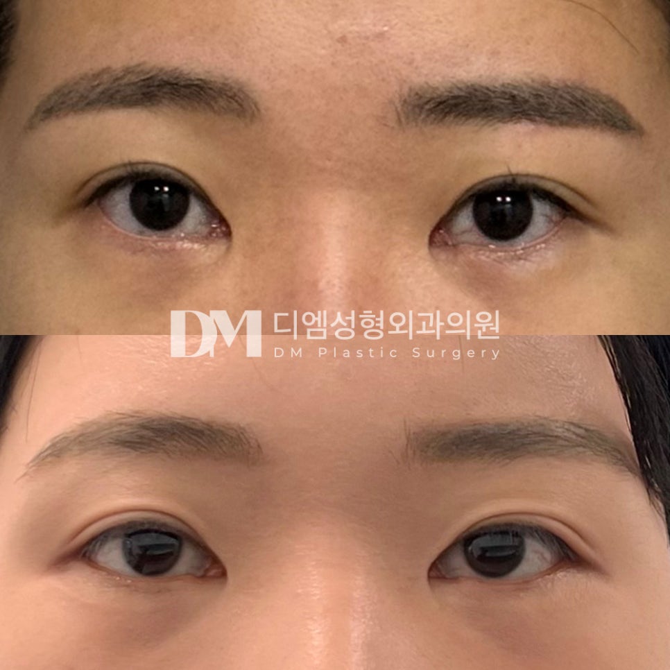 Lateral Canthoplasty Review: “I Have Absolutely No Regrets About the Surgery and Think I Made the Right Choice!” image 2