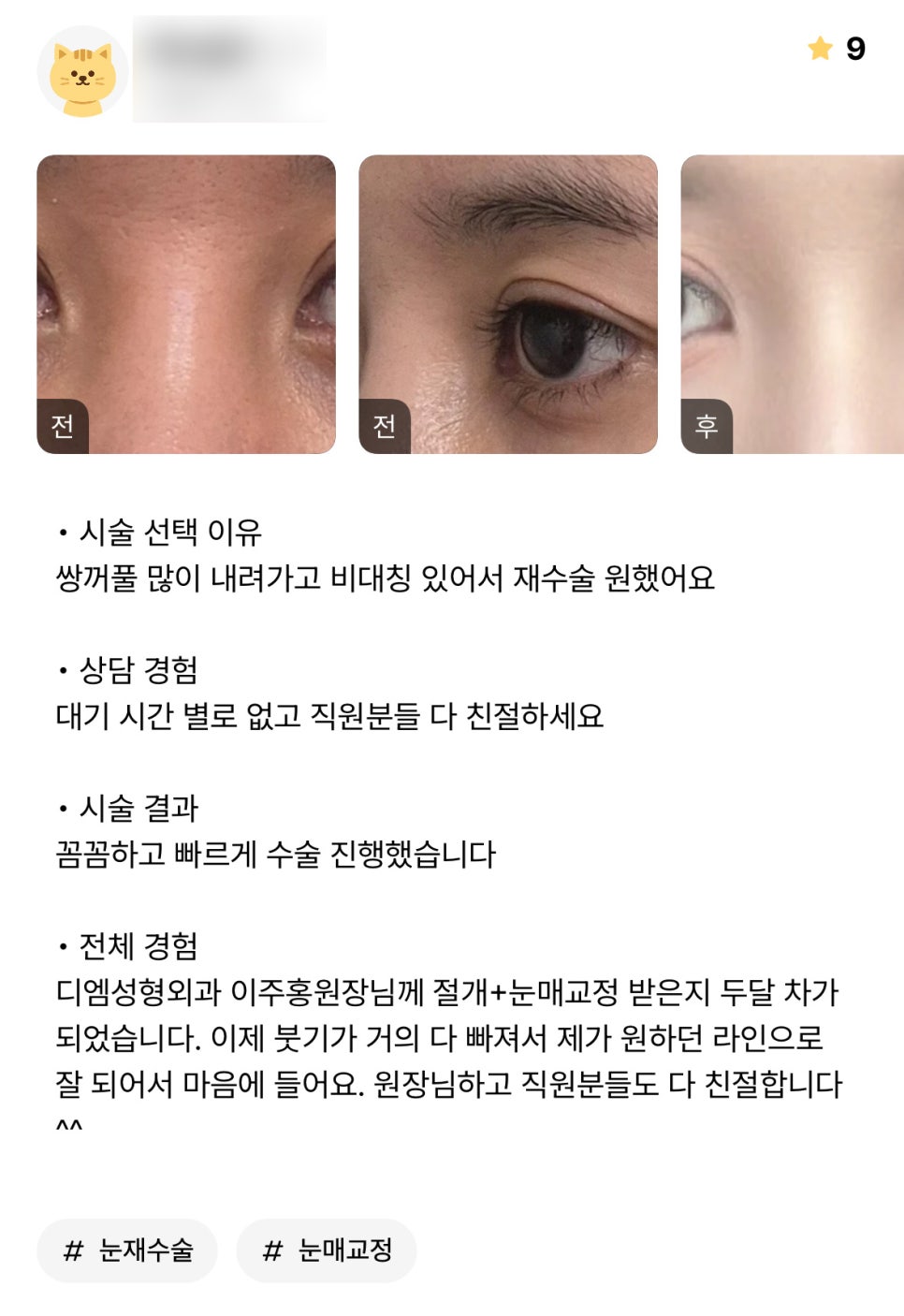 Eye Revision Surgery Review: “I’m happy that it turned out with the look I wanted!” image 1