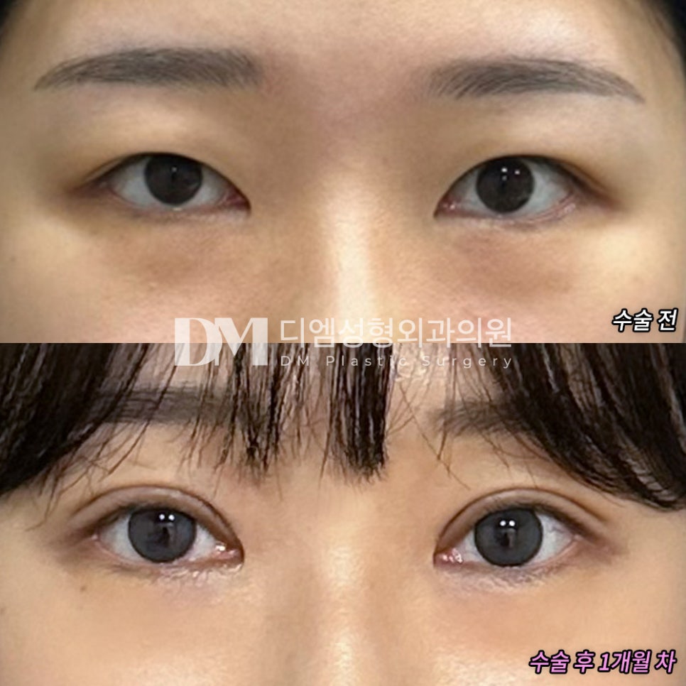 쌍꺼풀수술로 가볍고 또렷한 눈매 만들기 관련 이미지 10