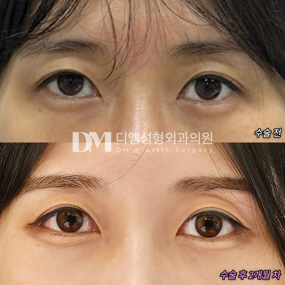 뒤밑트임, 디엠만의 노하우로 자연스럽게 빵! 트인 눈매 관련 이미지 5