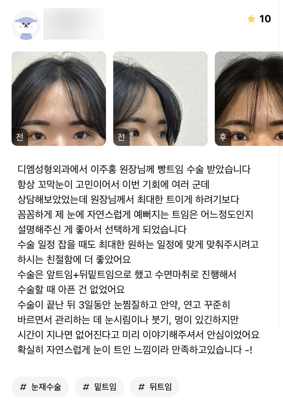 Canthoplasty Review. “I’m definitely satisfied because my eyes look naturally more open!” image 1