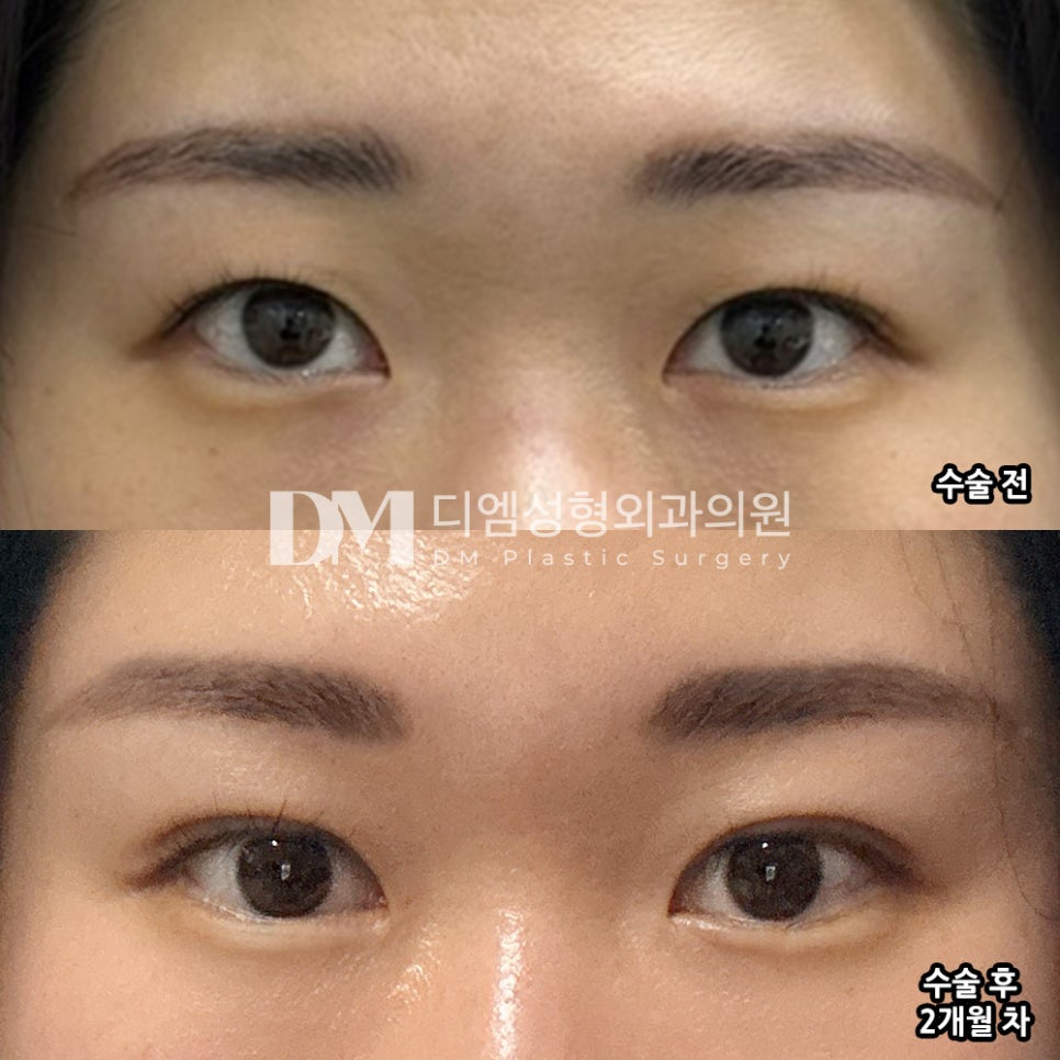Double-Eyelid Surgery Review: “My Eyes Look Defined Even Without Makeup!” image 2